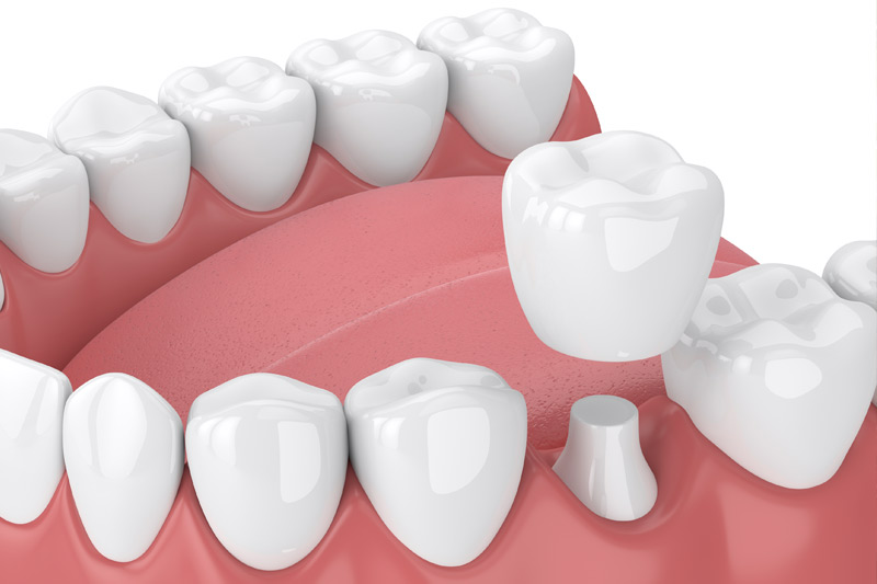 Dental Crowns in Lakewood