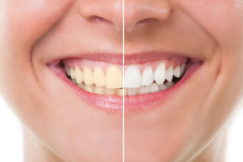 Teeth Whitening in Lakewood